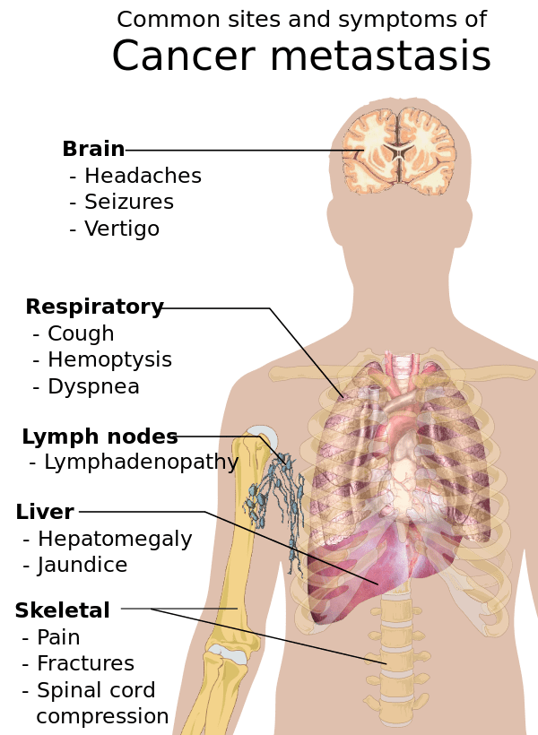 600px Symptoms of cancer metastasis.svg