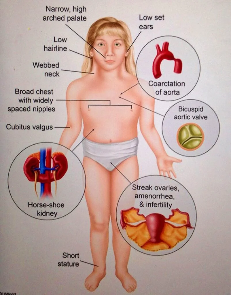गुणसूत्रीय विकार क्या है? टर्नर्स सिंड्रोम क्या होता है। 1 IMG 20230408 032539