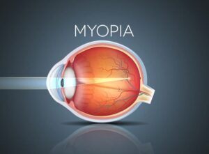 EffectivelyslowdownMyopia